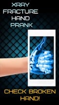 Xray Fracture Hand Prank Image