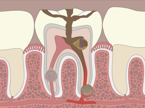 Microinvasión Image